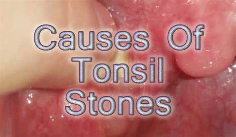 Pin On Causes Of Tonsils Stones