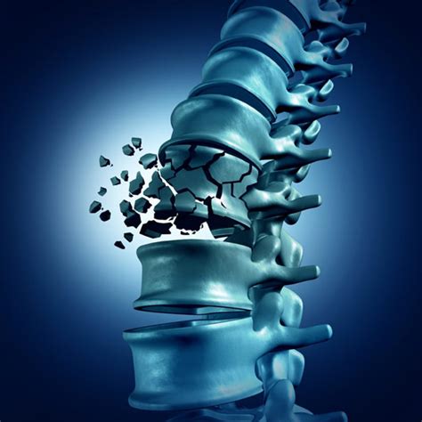 Spinal Cord Injury Diagnosis And Treatment In Long Island Ny Nns