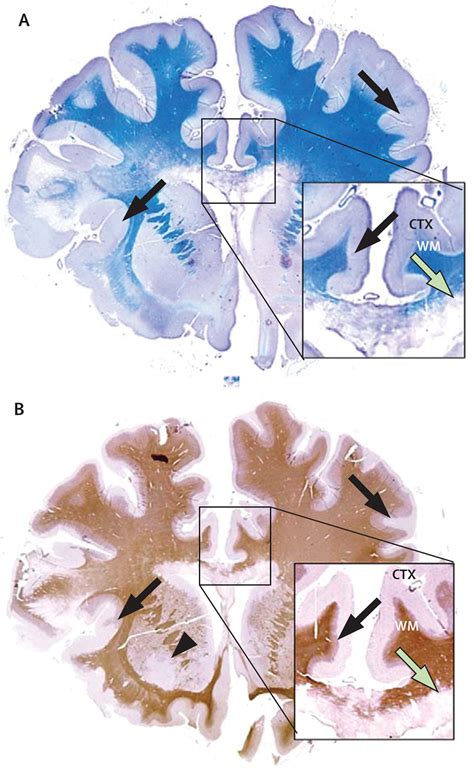 Grey Matter Pathology In Multiple Sclerosis The Lancet Neurology