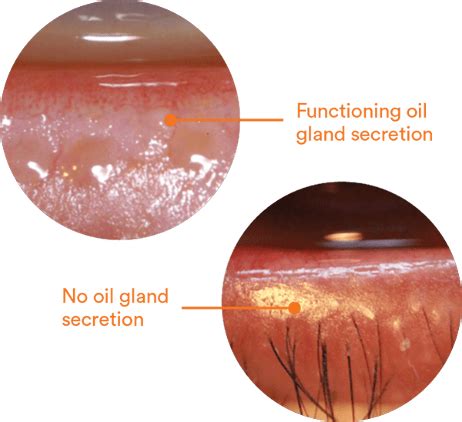 Meibomian Gland Dysfunction Mgd Killingly Eye Care