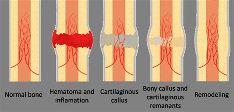 This process begins with hemorrhage and progresses through three stages: 3-Illustration of stages in bone healing after a fracture ...