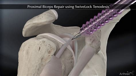 Arthrex Proximal Biceps Repair Using Swivelock Tenodesis