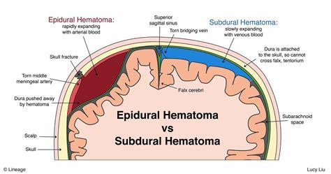Epidural Hematoma Step Neurology Step Medbullets Com