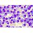 Plasma Cell Myeloma  Hematomorphology A Databank / Imagebank For