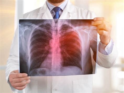 Bakteryjne zapalenie płuc przyczyny objawy i leczenie