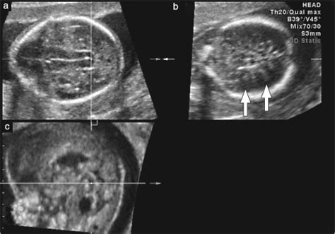 Multiplanar Three Dimensional Reconstructed Ultrasound Images Of The