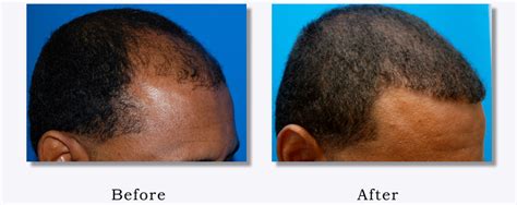 More research on the effects of peppermint essential oil on human hair is needed before calling it a cure for hair loss. Black Men & Women Hair Transplant Photos | Columbus, OH ...