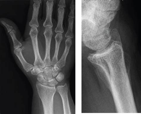 Ossified Dorsal Wrist Ganglion Cyst A Case Report Abstract Europe Pmc