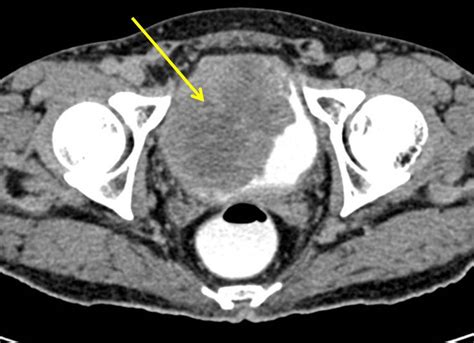 Squamous Cell Carcinoma Of Urinary Bladder Radiology Cases