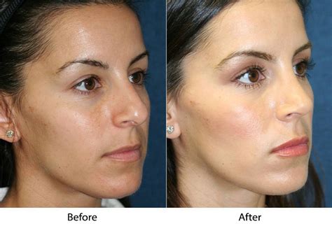 Nose Job In Los Altos And San Jose Ca Find The Best Surgeon