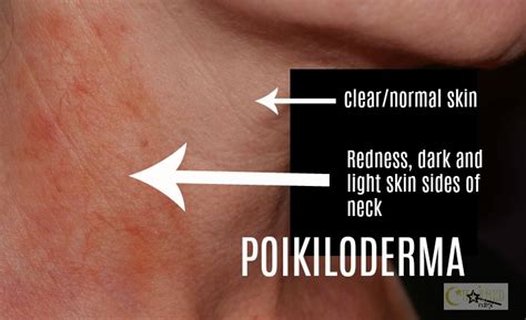 Do You Have This Common Neck Discoloration Called Poikiloderma