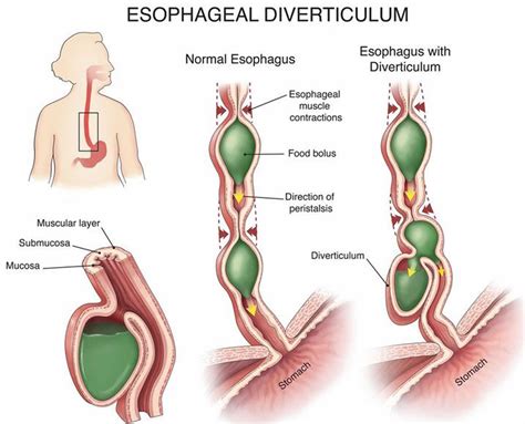 Esophageal Diverticulum Causes Types Symptoms Diagnosis And Treatment