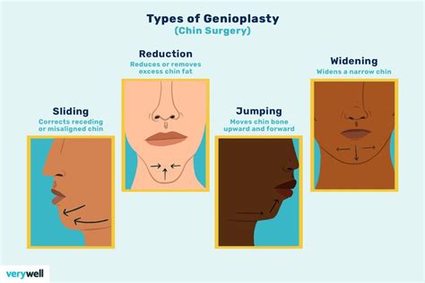 Genioplasty Overview