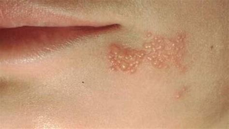 Free medical advise about herpes simplex genital. HSV-1 - Symptoms & Causes