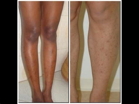 How To Get Rid Of Dark Spots On Legs Part Youtube Dark Spots On