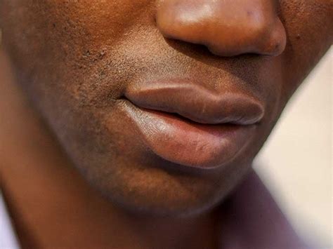 Black Spots On Lips Causes