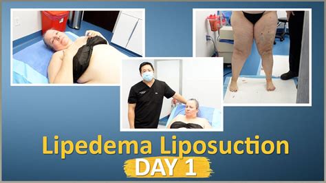Lipedema Liposuction Surgery Results Lipo Legs Cankles Knees Expert Dr Thomas Su