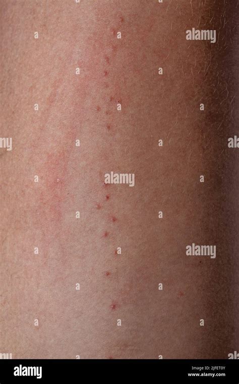 Human Skin With Various Allergic Reactions To Tick Bites With Selective