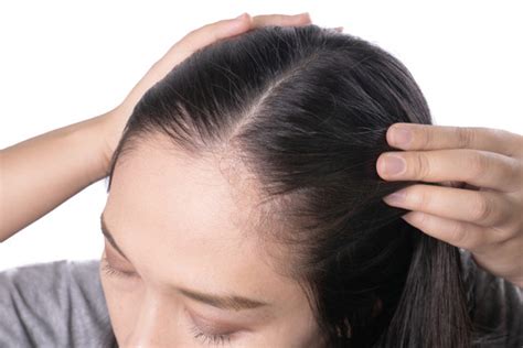 5 Gentle Home Remedies To Treat Hairline Acne With Tips To Follow