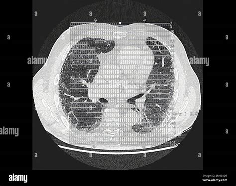 Tomography Of Lungs Suffering From Interstitial Pneumonia Computed