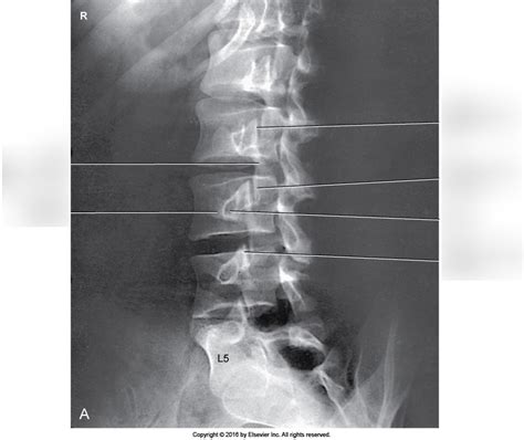 Figure 08 98a A Ap Oblique Lumbar Spine Rpo For Right Zygapophyseal
