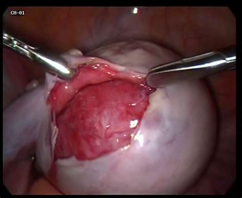 Dermoid Cyst Of The Ovary All Information About Cysts