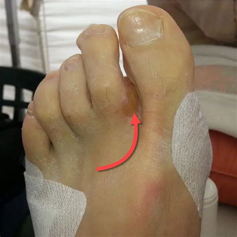 Distal Forefoot Blisters A Confusing Blister Location