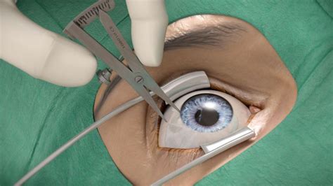 Intravitreale Injektion Augenarzt Dr Schnitzler