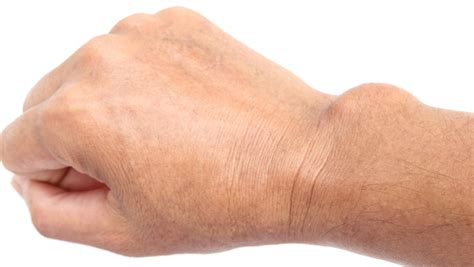 That Bump On Your Wrist Is Likely A Ganglion Cyst Uchicago Medicine