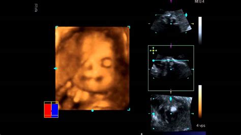 3d 4d ultrasound youtube