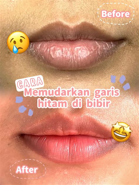 Cara Menghilangkan Garis Hitam Di Bawah Bibir - KoranSidak.co.id