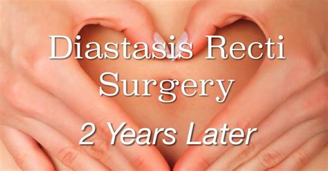 How To Fix Diastasis Recti Years Later Surgery