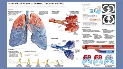 Infografía Explicativa De La Enfermedad Pulmonar Obstructiva Crónica 75E