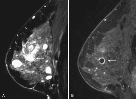 Benign Findings In Breast Mri Radiology Key