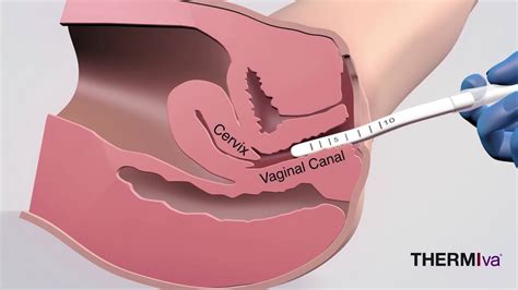 Vaginal Rejuvenation And Tightening Procedures In New York Juva Skin