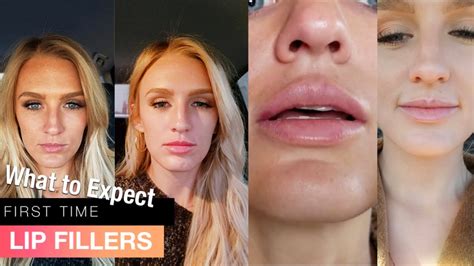 My First Time Getting Lip Fillers Before And After 1 Syringe Juvederm