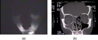 Near Infrared Imaging Of The Sinuses Preliminary Evaluation Of A New Technology For Diagnosing