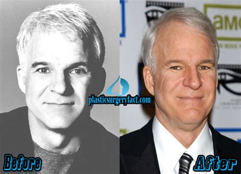Steve Martin Plastic Surgery Before And After Photos