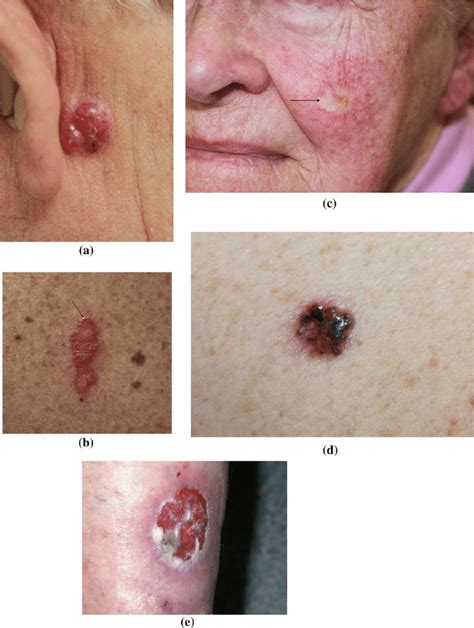 Clinical Images Of Types Of Bcc A Bcc B Superficial Bcc C Morphoeic