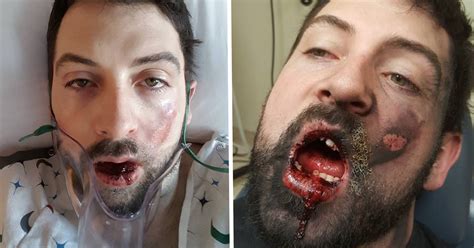 Most kids stop grinding when they lose their baby teeth. Man loses seven teeth when a vape explodes in his face