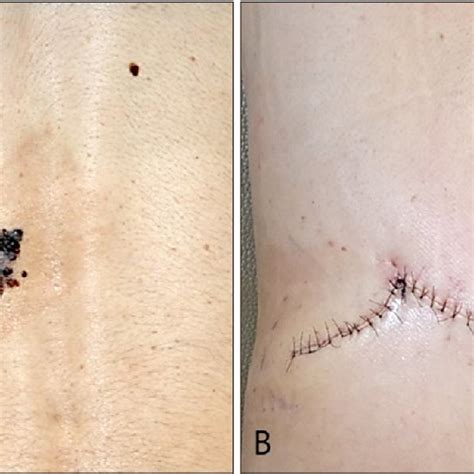 Application Of The Slideswing Skin Flap A Preoperative Design Of The