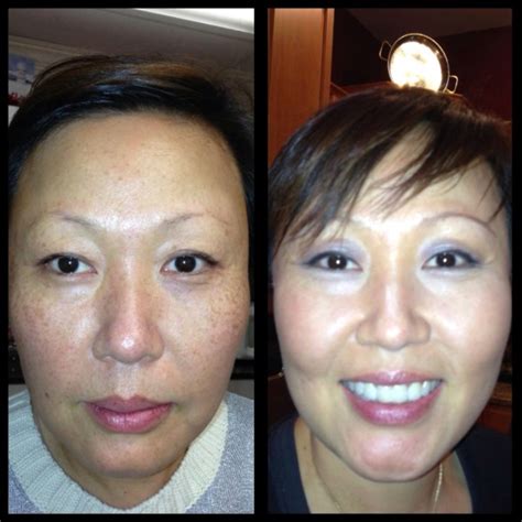 Ipl Photofacial In Washington Dc And Olney Cosmetic Skin Institute