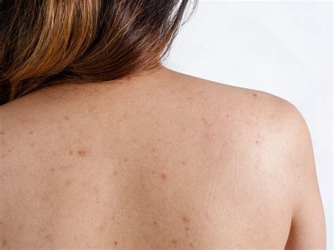 Pickelmale stirn / pickel entfernen hausmittel und tipps um sie schnell loszuwerden brigitte de / dein cremiger helfer gegen pickelmale ist zinksalbe, genau genommen die zinkoide darin. What causes back pimples - Insider