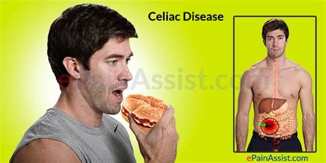 Celiac Disease Treatment Causes Symptoms Signs Risk Factors