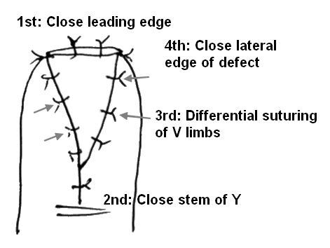 Volar V Y Advancement Flap For Fingertip Amputations Epomedicine