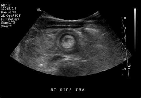 Intussusception Image