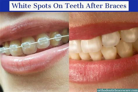 White Spots On Teeth After Braces Causes How To Fix Orthodontic Braces Care
