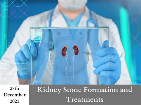 Kidney Stone Formation And Treatments Symptoms Of Kidney Stone