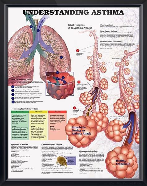 Understanding Asthma Chart 20x26 Pulmonology Asthma Treatment Asthma