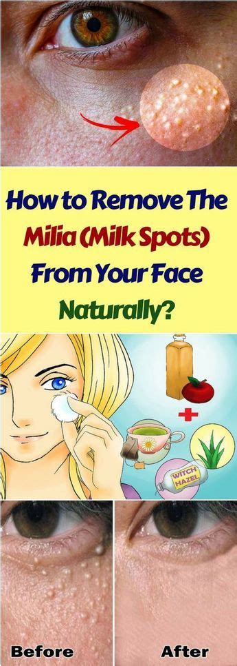 How To Remove The Milia Milk Spots From Your Face Naturally Bumps